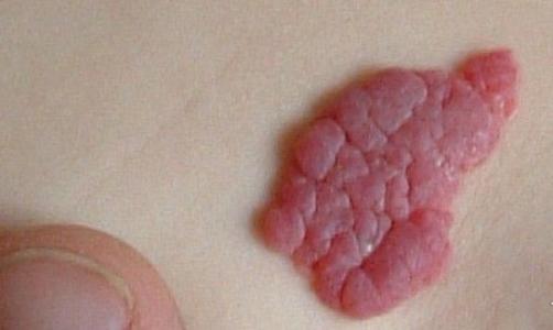 患者疑问：宝宝草莓状血管瘤是什么，有危害吗？